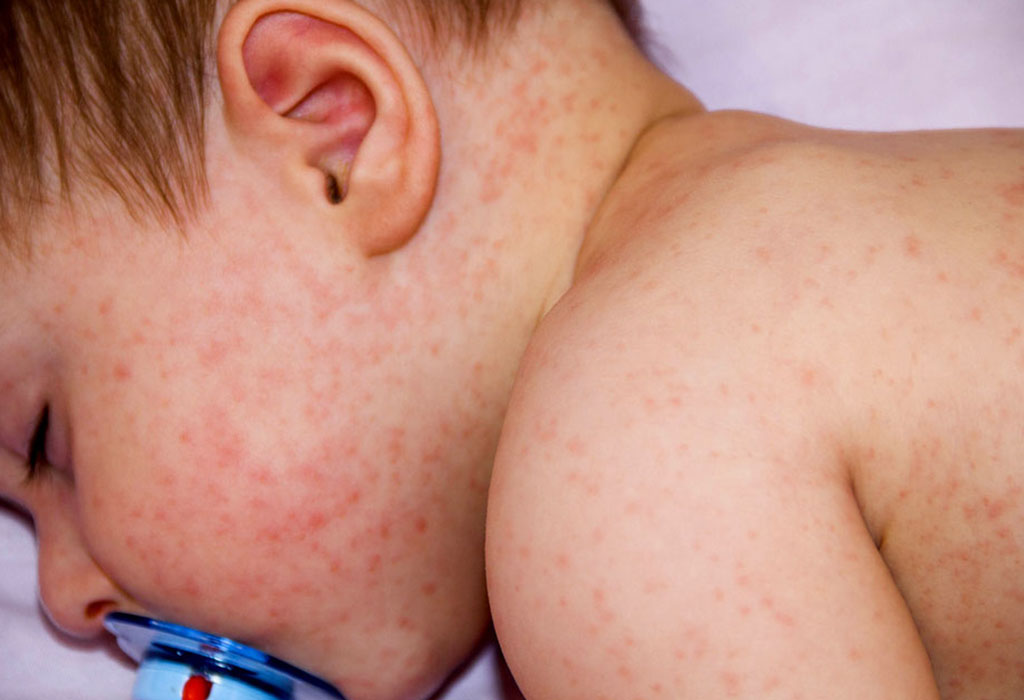 Common Skin Allergies In Babies