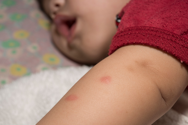 Укусы комаров у детей Симптомы, домашние средства и профилактика
