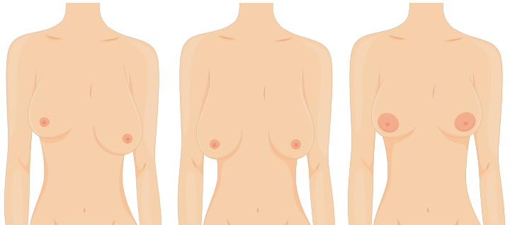 Почему грудь склонна опускаться после грудного вскармливания и как ее предотвратить?